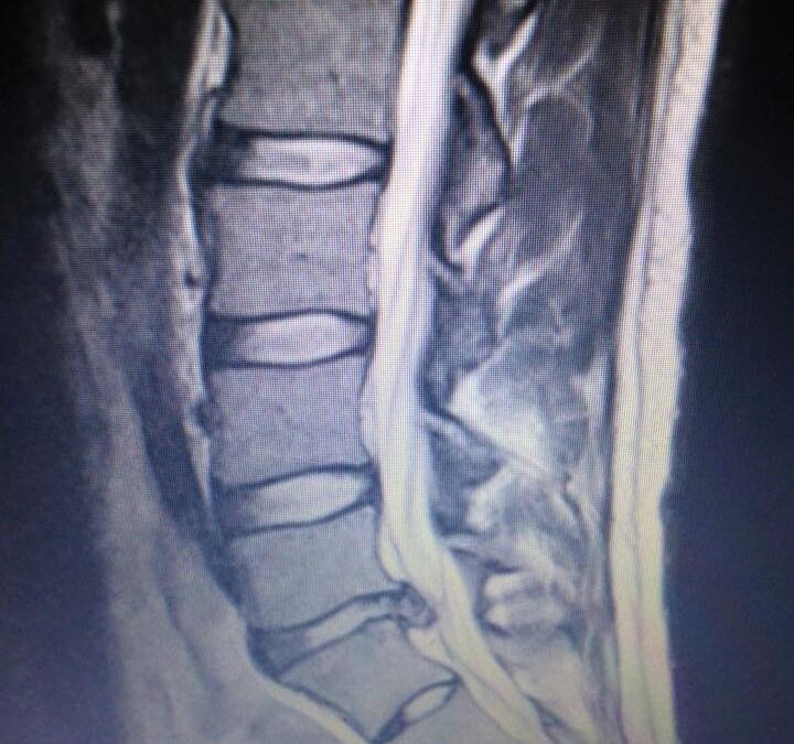 Low back MRI of a herniated disc